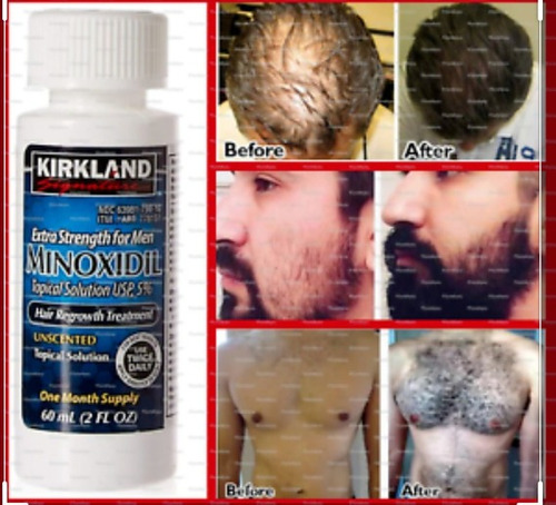 Minoxidil Cabello Barba Pelo Alopecia Crecimiento Caida